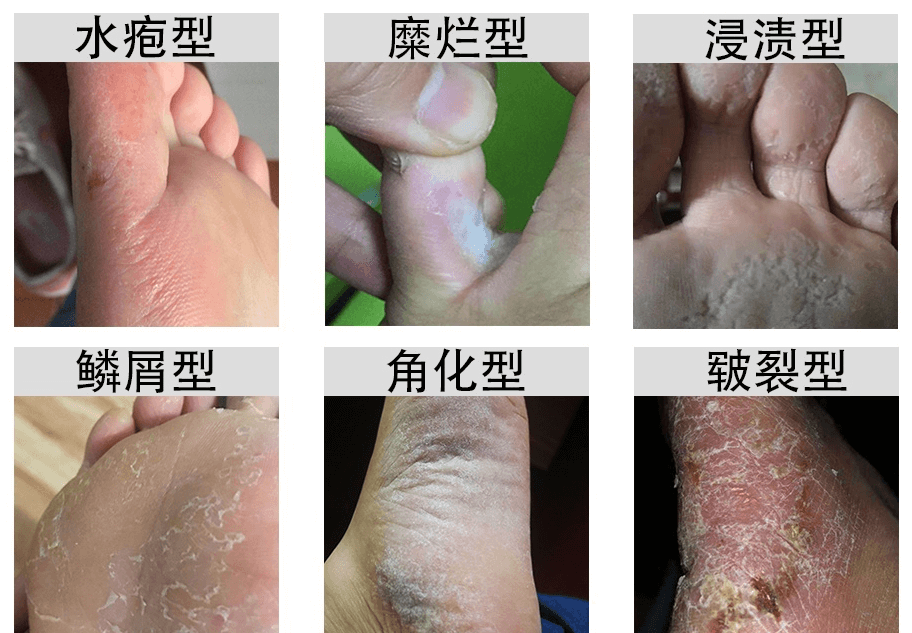 63df3af989c1ewVrJ3ZKNmbE4oSGR - 从治脚气到脚气药进驻三四线城市洗脚店的经历复盘，每月被动收入纯利润5W+
