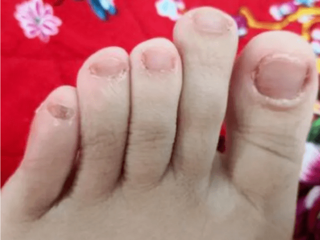 图片[3]-史上最全去灰小妙招！过来人建议：认准这3个，再顽固的灰指甲也能治好！-草根创业生活网