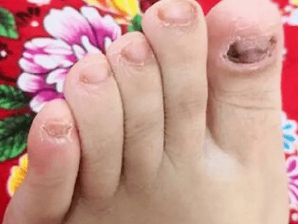 图片[1]-史上最全去灰小妙招！过来人建议：认准这3个，再顽固的灰指甲也能治好！-草根创业生活网