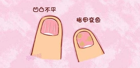 图片[1]-哪些人容易得灰指甲？-草根创业生活网