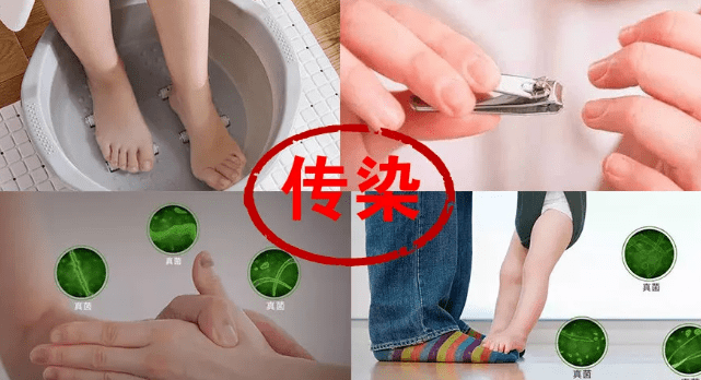 图片[3]-哪些人最容易招灰指甲喜欢？-草根创业生活网