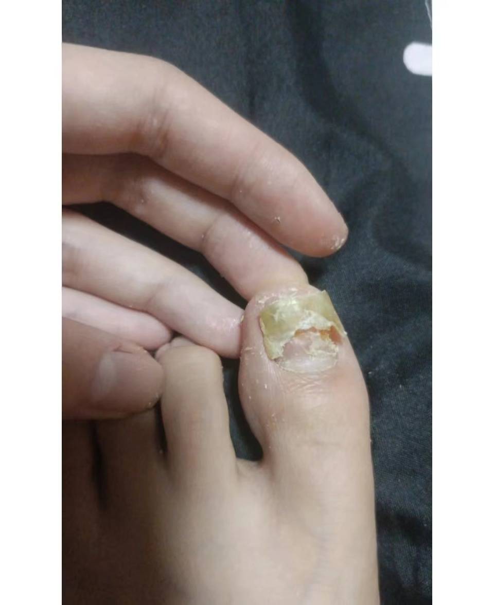 图片[1]-在家就能根治灰指甲？3个妙招灰指甲人群抢着用，每天才花几毛钱！-草根创业生活网