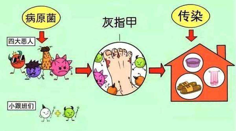 图片[2]-得了灰指甲不要怕！-草根创业生活网