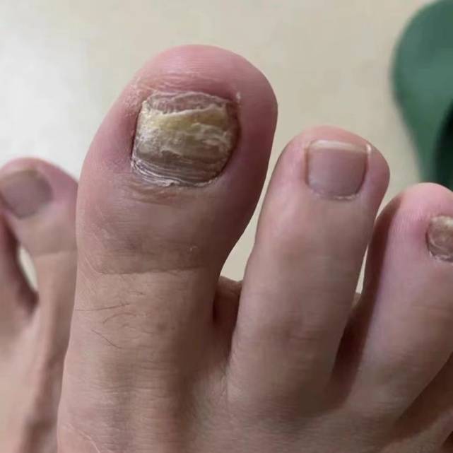 图片[1]-得了灰指甲怎么办？千万不能用手抠，每天三分钟泛黄增厚指甲去无踪！-草根创业生活网