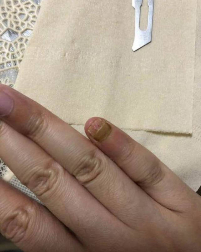 图片[2]-灰指甲怎么治？皮肤科内部方法总结：做好这2件事，告别灰指甲！-草根创业生活网