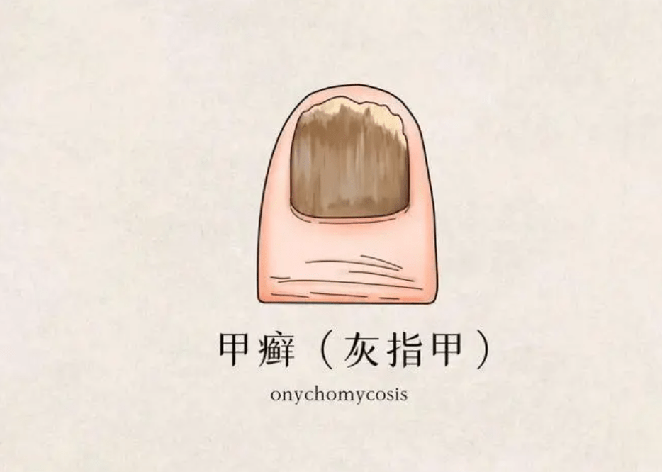 图片[1]-得了“灰指甲”，如何能“亮甲”？-草根创业生活网