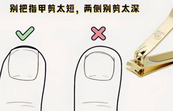 图片[2]-得了灰指甲，易传染？-草根创业生活网