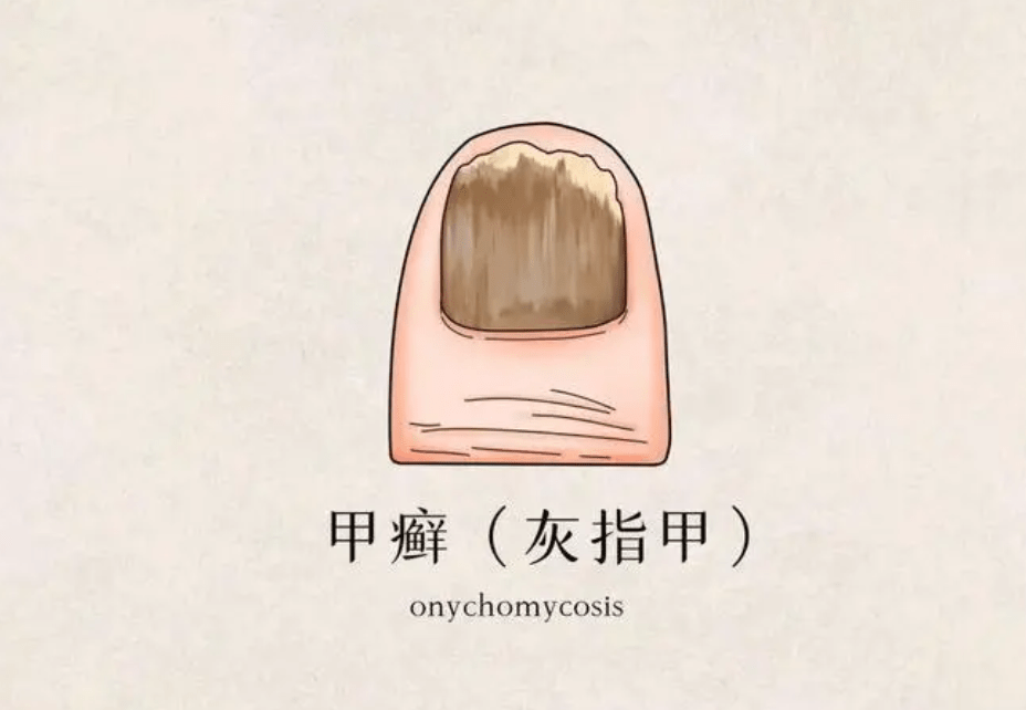 图片[1]-怎样治疗严重的灰指甲？-草根创业生活网