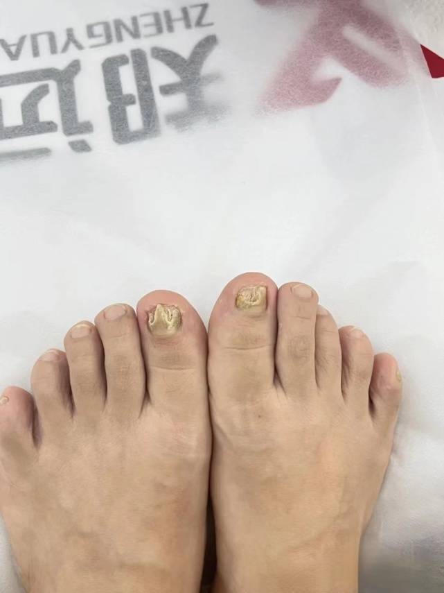 图片[1]-指甲发黄增厚剪不动？过来人教你这几招，轻松在家清除顽固灰指甲-草根创业生活网
