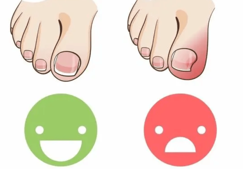 图片[2]-灰指甲一定会脱落甲片吗？-草根创业生活网