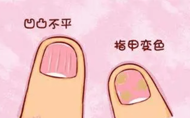 图片[2]-灰指甲有什么特征？-草根创业生活网
