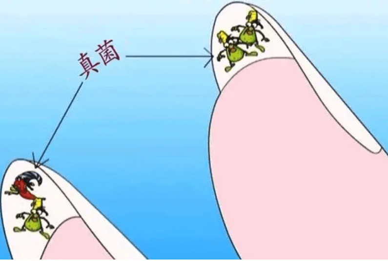 图片[1]-灰指甲有什么特征？-草根创业生活网
