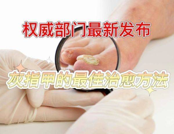 图片[1]-灰指甲的最佳治愈方法！-草根创业生活网
