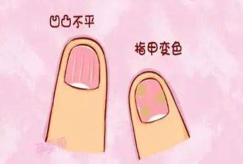 图片[1]-灰指甲的治疗方法是什么呢?-草根创业生活网