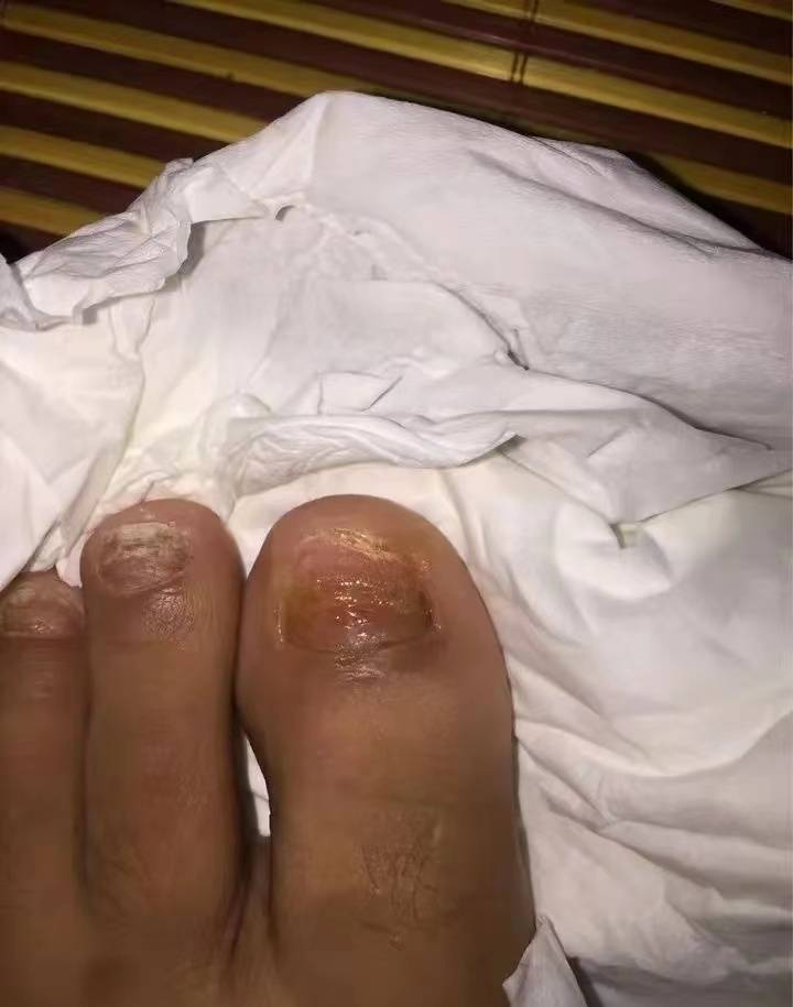 图片[3]-灰指甲除根真不难！每天做到这2点，不出3个月泛黄增厚指甲秒没！-草根创业生活网