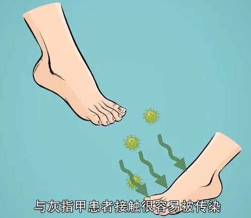 图片[2]-究竟该怎样根治灰指甲呢?-草根创业生活网