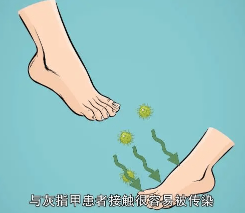 图片[2]-灰指甲除根要多久？-草根创业生活网
