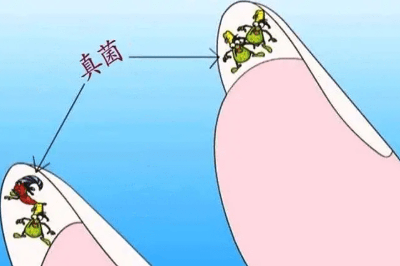 图片[3]-重度灰指甲必看!轻松摆脱丑指甲!-草根创业生活网