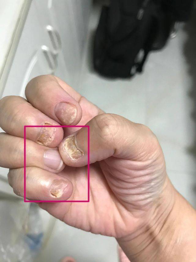 图片[1]-一家四口十来个发黄增厚指甲全好了！这样做治一个好一个！-草根创业生活网