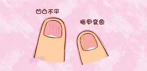 图片[1]-拿什么来拯救灰指甲-草根创业生活网