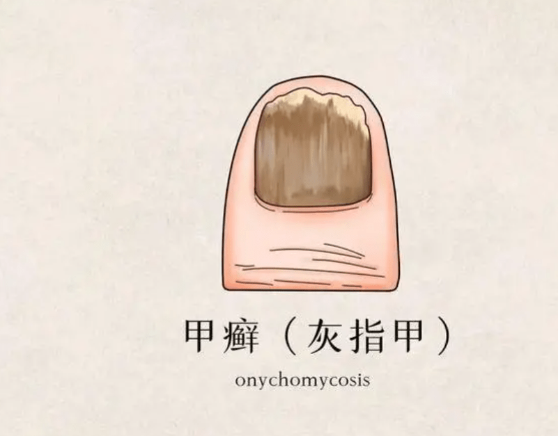 图片[1]-灰指甲怎么治？-草根创业生活网