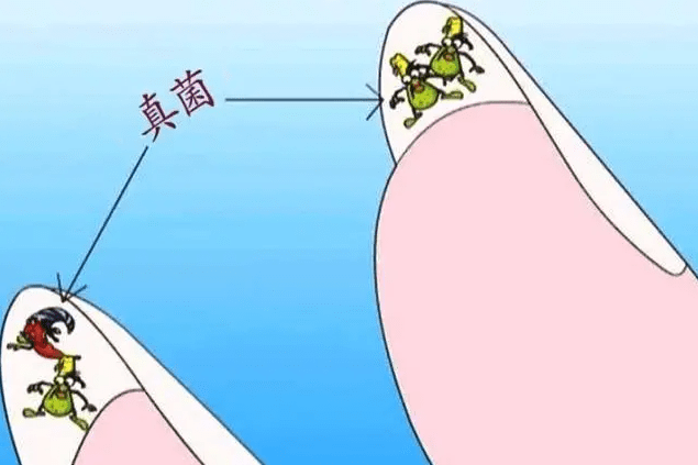 图片[2]-灰指甲是什么原因造成有什么危害？-草根创业生活网
