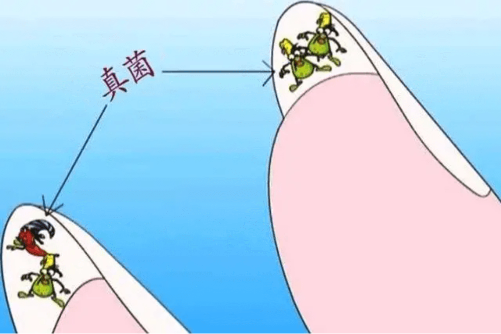 图片[3]-灰指甲有什么特征？灰指甲女孩们！-草根创业生活网