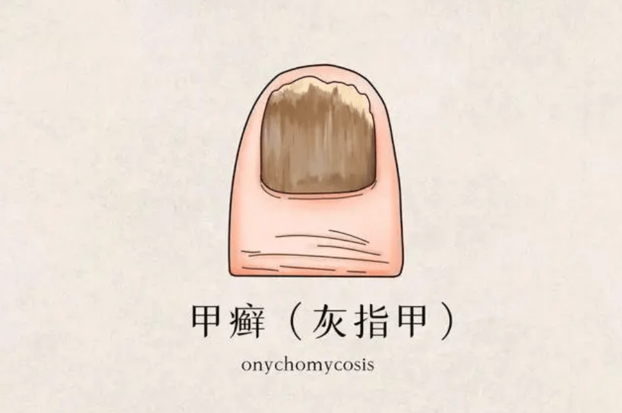 图片[1]-灰指甲用什药能有效根治？-草根创业生活网