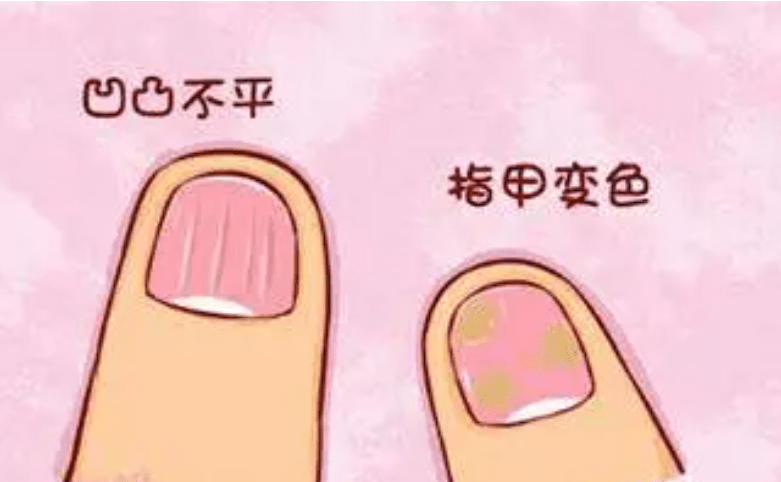 图片[2]-营养不良竟然惹来灰指甲，怎么做才能保护好指甲呢?-草根创业生活网